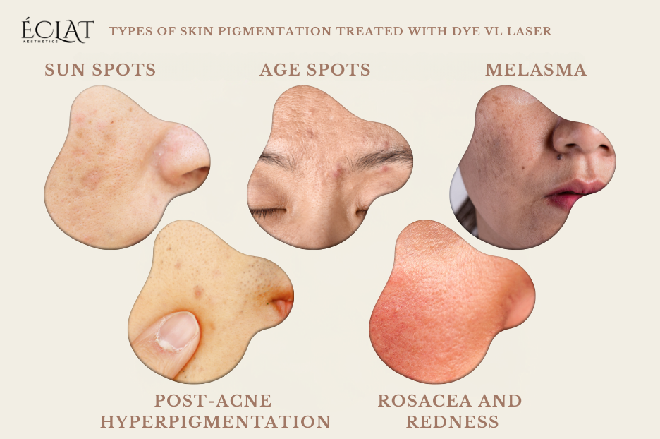 How Dye VL Laser Erases Pigmentation Safely Say Goodbye to Sunspots 3 Types of Skin Pigmentation Treated with Dye VL Laser