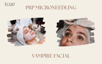 PRP Microneedling | Vampire Facial That Actually Works on Acne Scar