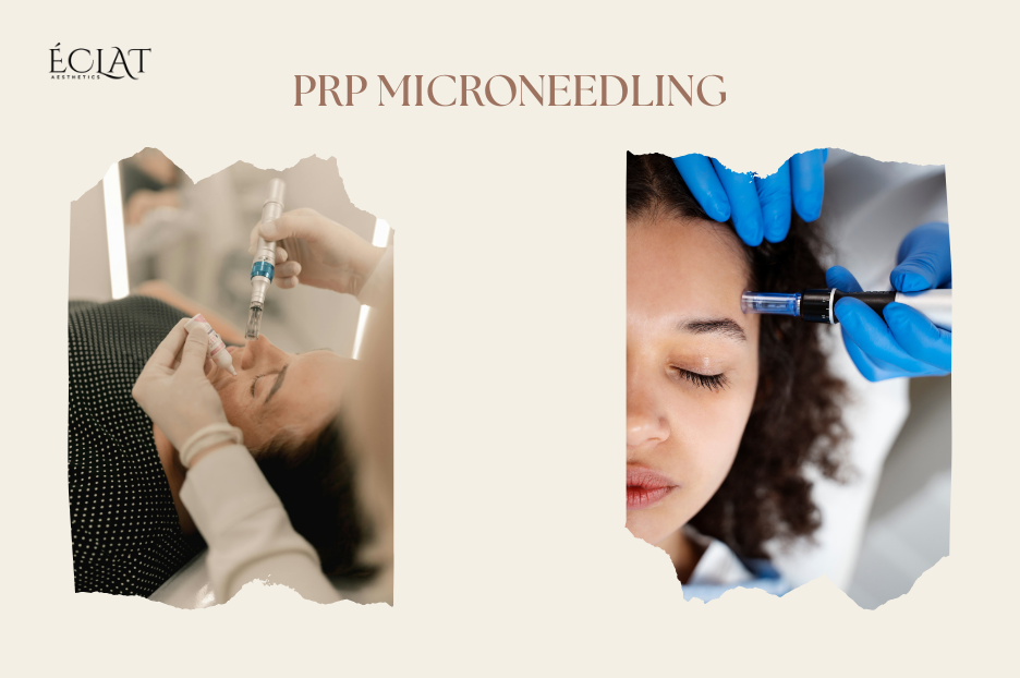 PRP Microneedling Vampire Facial That Actually Works on Acne Scar PRP Microneedling | Vampire Facial That Actually Works on Acne Scar