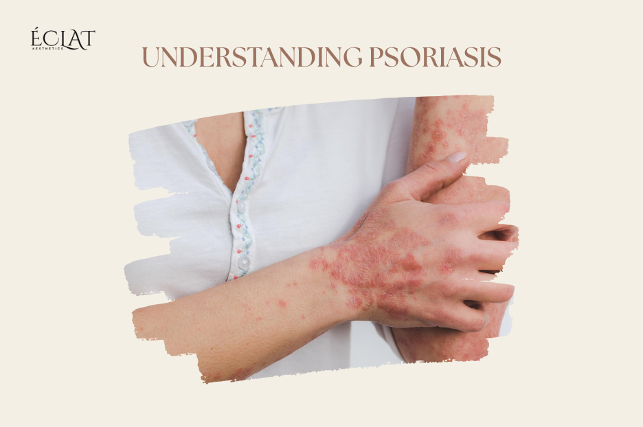 UV Light Therapy Dermatologists' Secret Weapon for Psoriasis & Acne Treatment UV Light Therapy | Dermatologists' Secret Weapon for Psoriasis & Acne Treatment