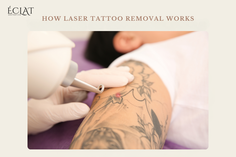 How Laser Tattoo Removal Works
