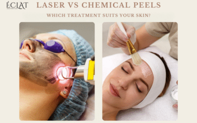 Laser Treatment vs Chemical Peels