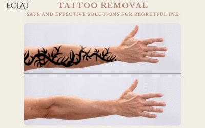 Tattoo Removal | Safe and Effective Solutions for Regretful Ink