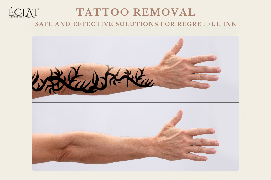 Tattoo Removal Safe and Effective