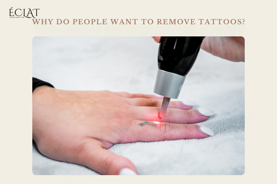 Why Do People Want to Remove Tattoos?