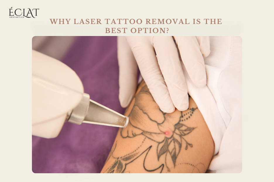Why Laser Tattoo Removal is the Best Option?