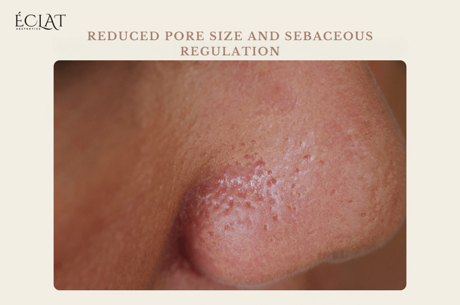 Reduce pors size Reduce pors size