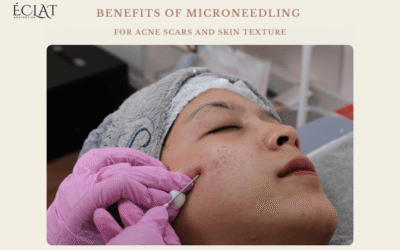 Benefits of Microneedling for Acne Scars and Skin Texture