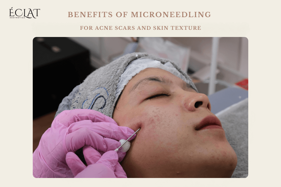 Benefits of Microneedling for Acne Scars and Skin Texture