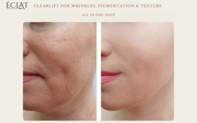 ClearLift for Wrinkles, Pigmentation & Texture — All in One Shot