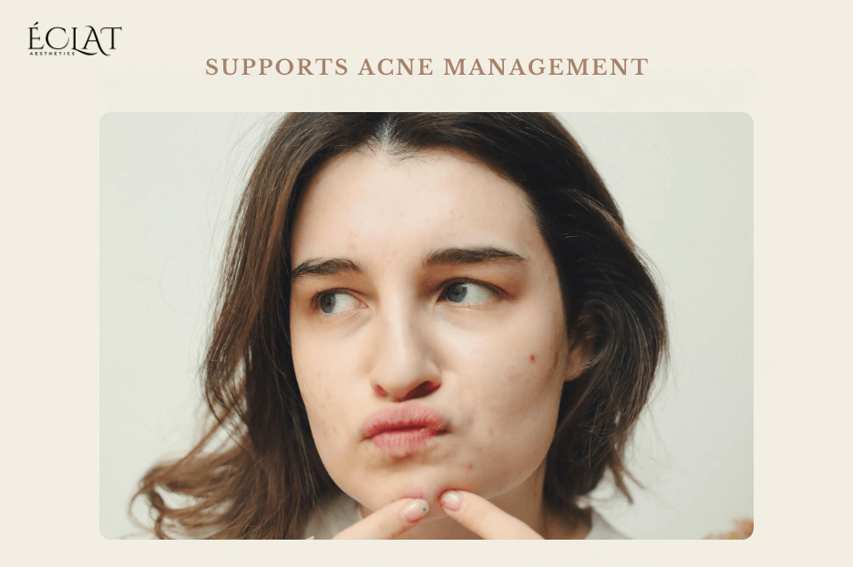 Supports Acne Management Supports Acne Management