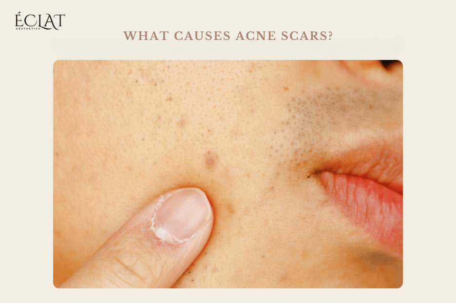 What Causes Acne Scars