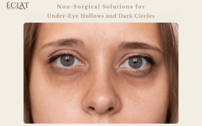 Non-Surgical Solutions for Under-Eye Hollows and Dark Circles