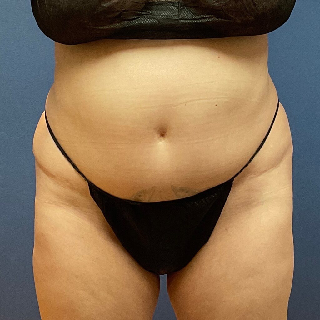 Front view of a woman's lower midsection and thighs