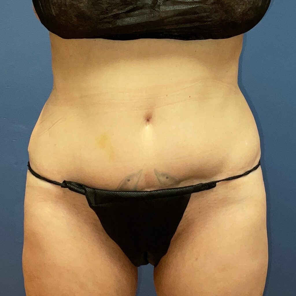 Front view of a woman's lower midsection.