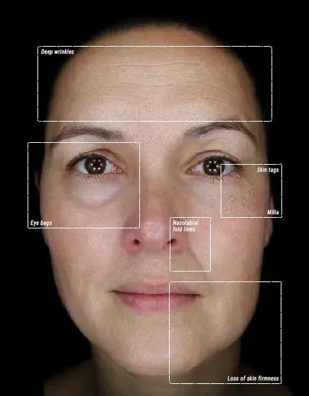 Facial skin analysis