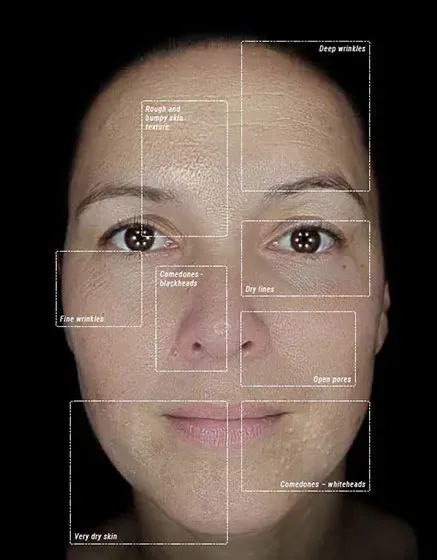 Facial skin analysis