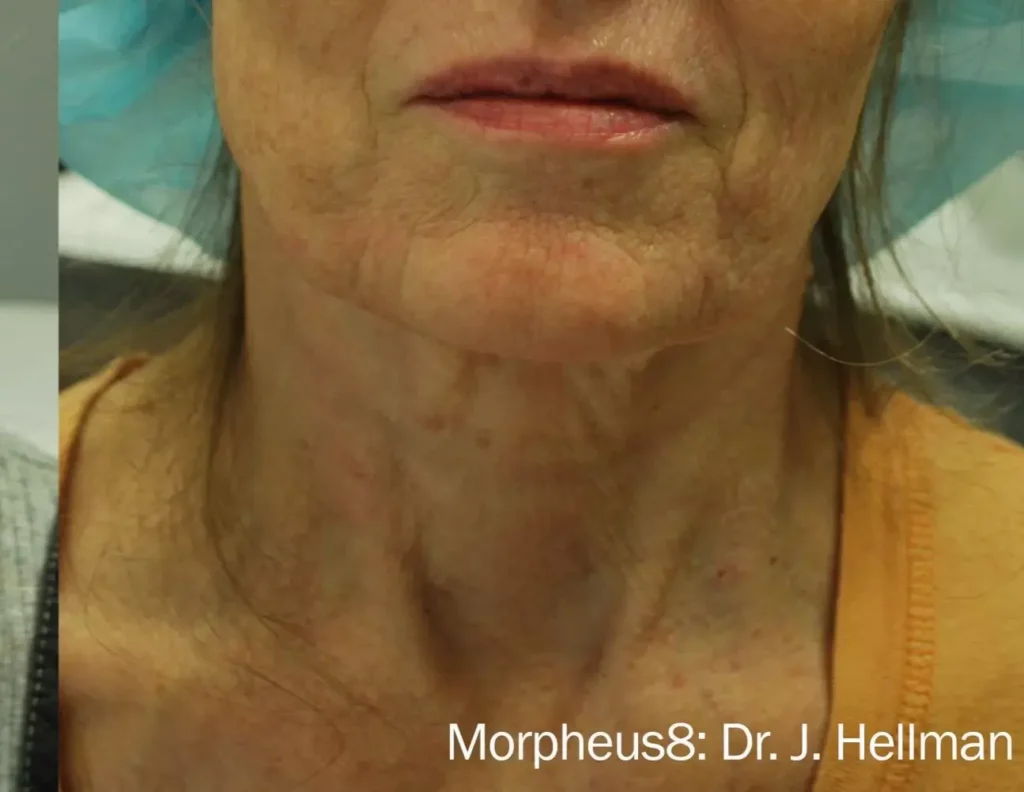 morpheus8-before