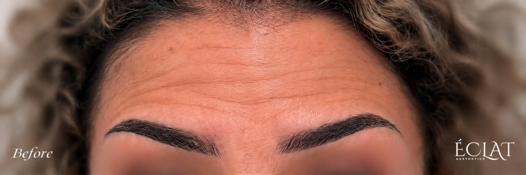 Botox before treatment at Éclat Medical Aesthetics