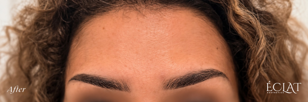 Botox after treatment at Éclat Medical Aesthetics