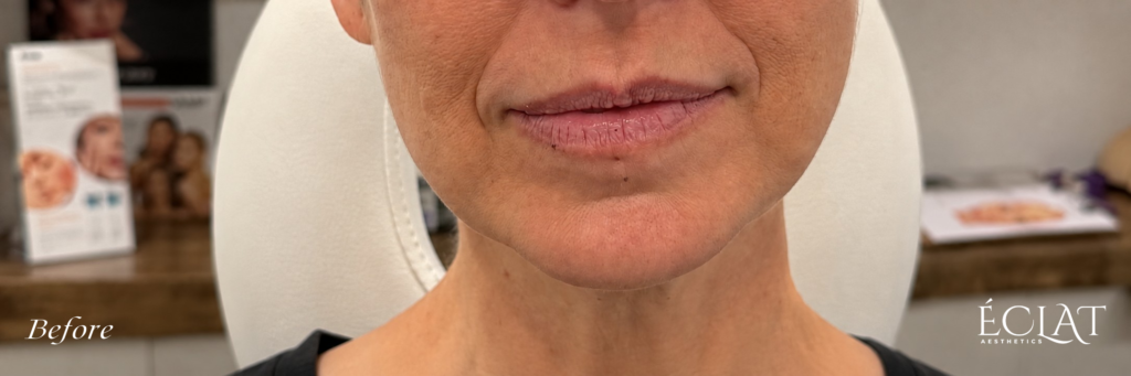 Lip Filler before treatment at Éclat Medical Aesthetics