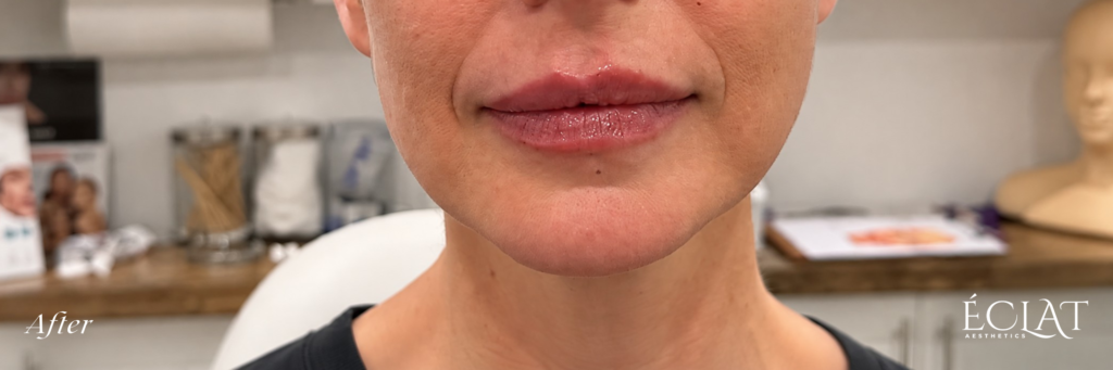Lip Filler after treatment at Éclat Medical Aesthetics