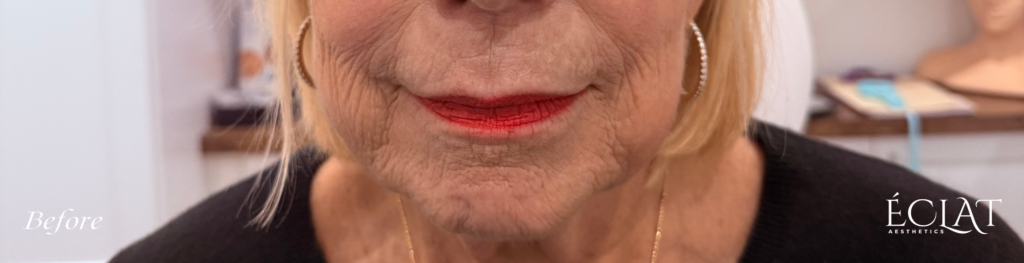 Morpheus8 before treatment at Éclat Medical Aesthetics
