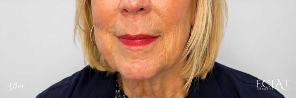 Morpheus8 after treatment at Éclat Medical Aesthetics