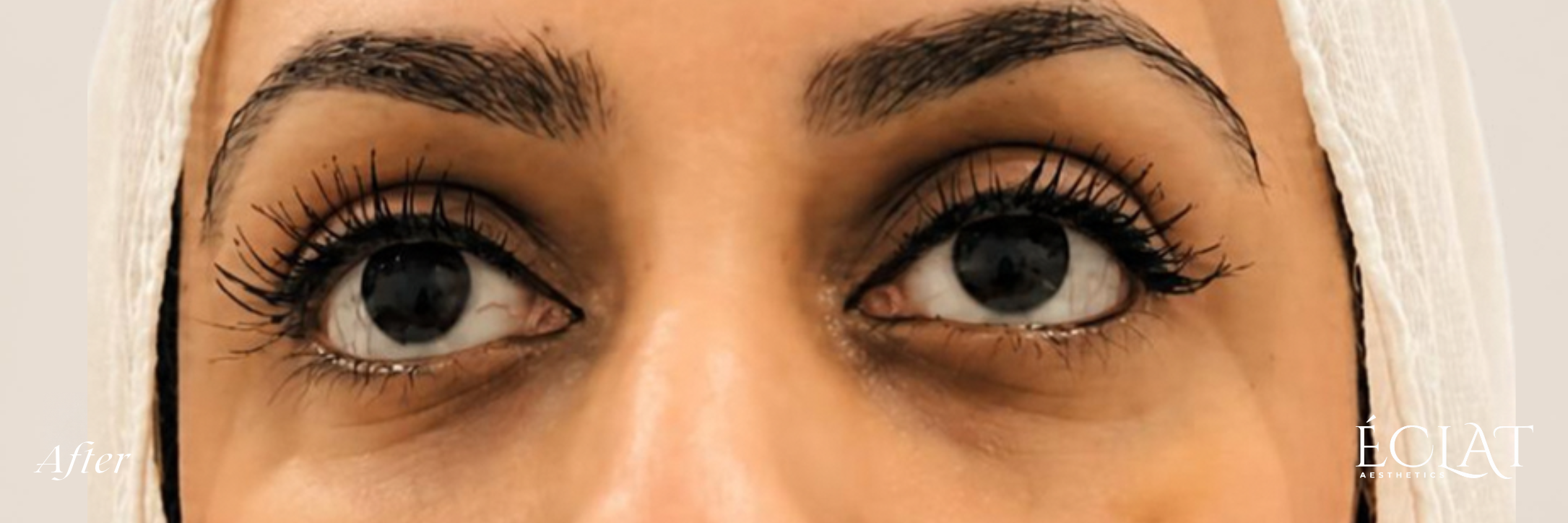 PRF Under Eyes after treatment at Éclat Medical Aesthetics