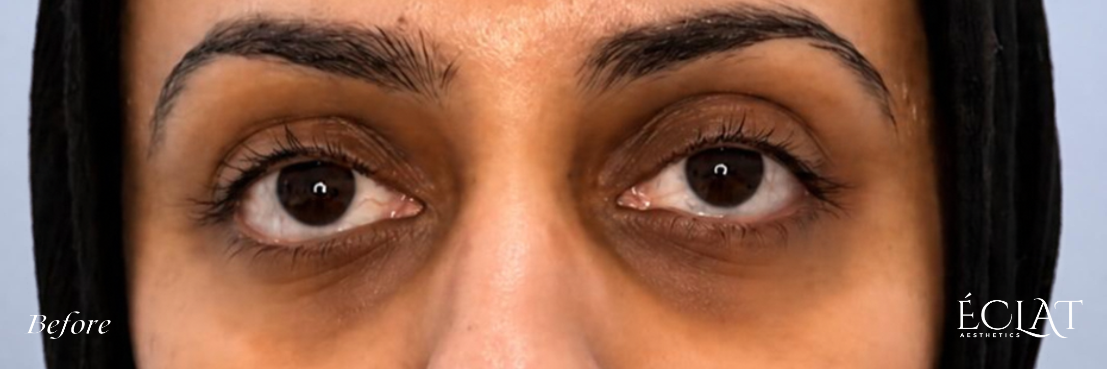 PRF Under Eyes before treatment at Éclat Medical Aesthetics