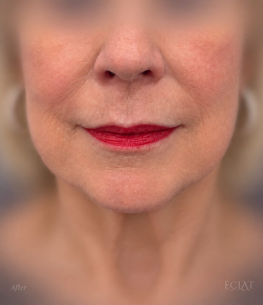 Morpheus8 after treatment at Éclat Medical Aesthetics