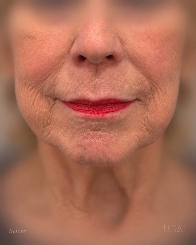 Morpheus8 before treatment at Éclat Medical Aesthetics